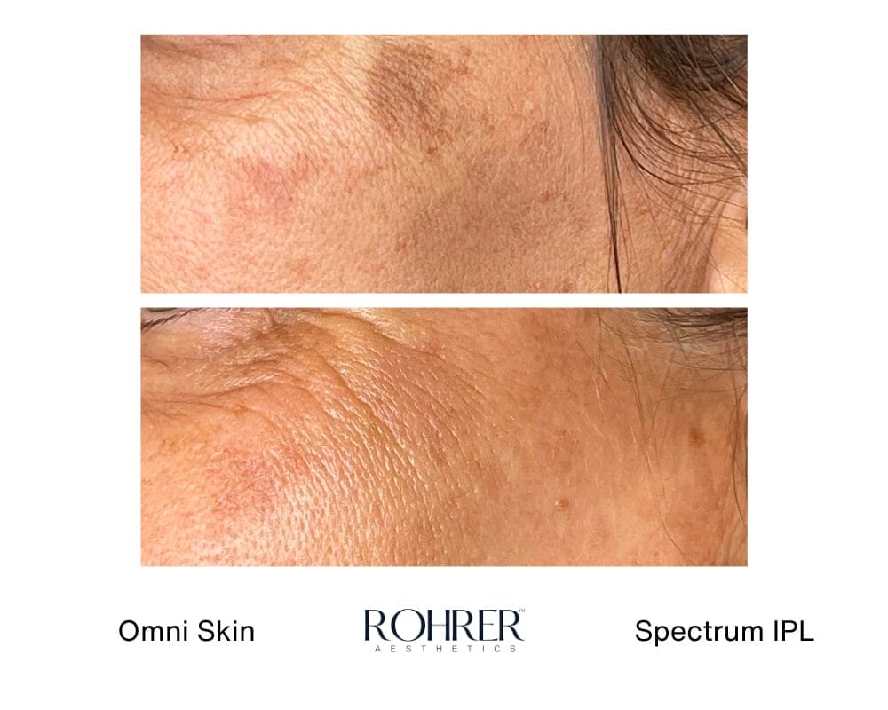 IPL-6 Spectrum IPL Before and After