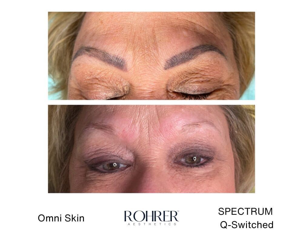 Spectrum-Erbium-YAG-6 Erbium Yag Laser Treatment - Tattoo Removal